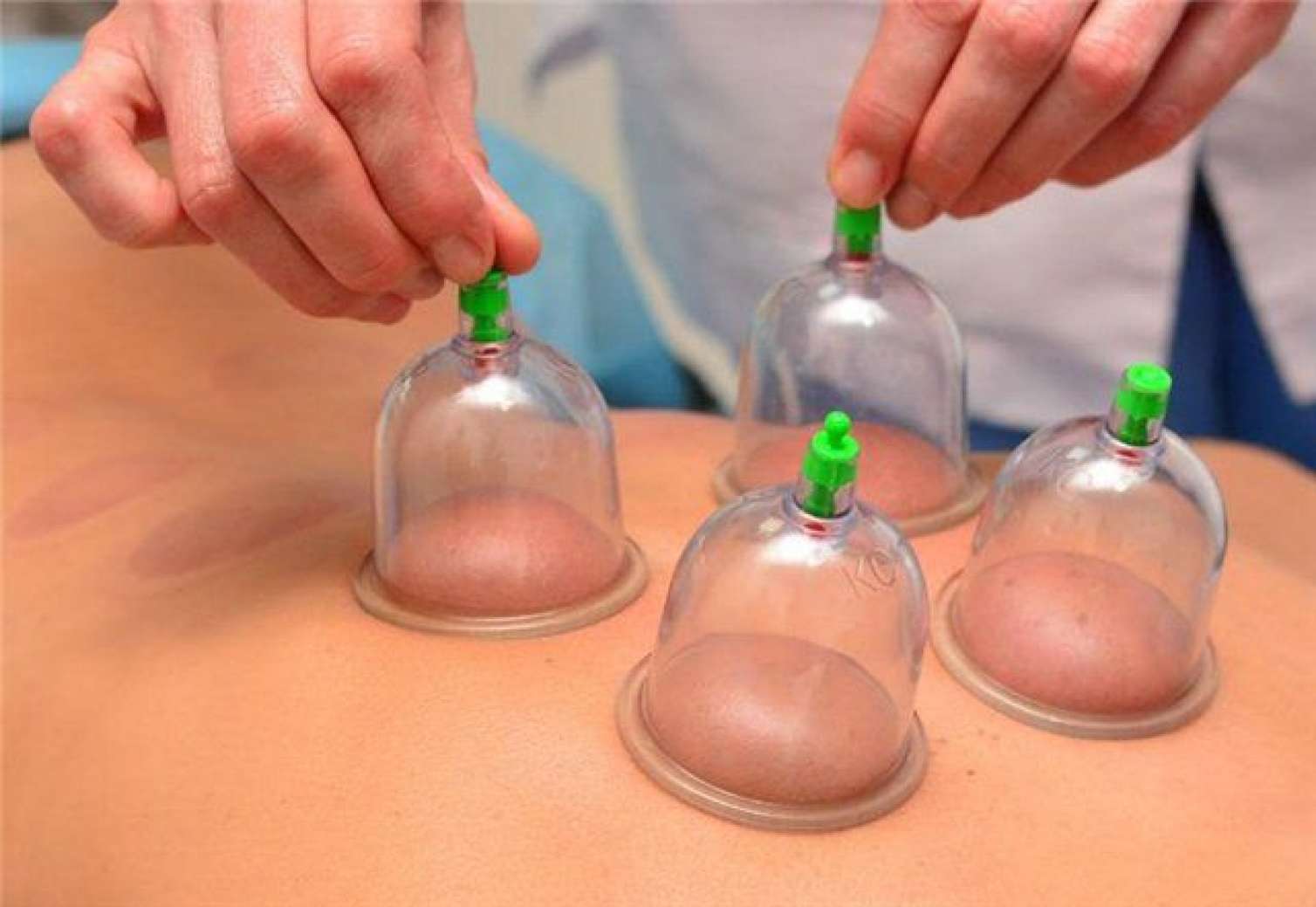 Pnevmoniya xəstəsinə banka qoymaq olmaz -  Ağırlaşmaya səbəb olur