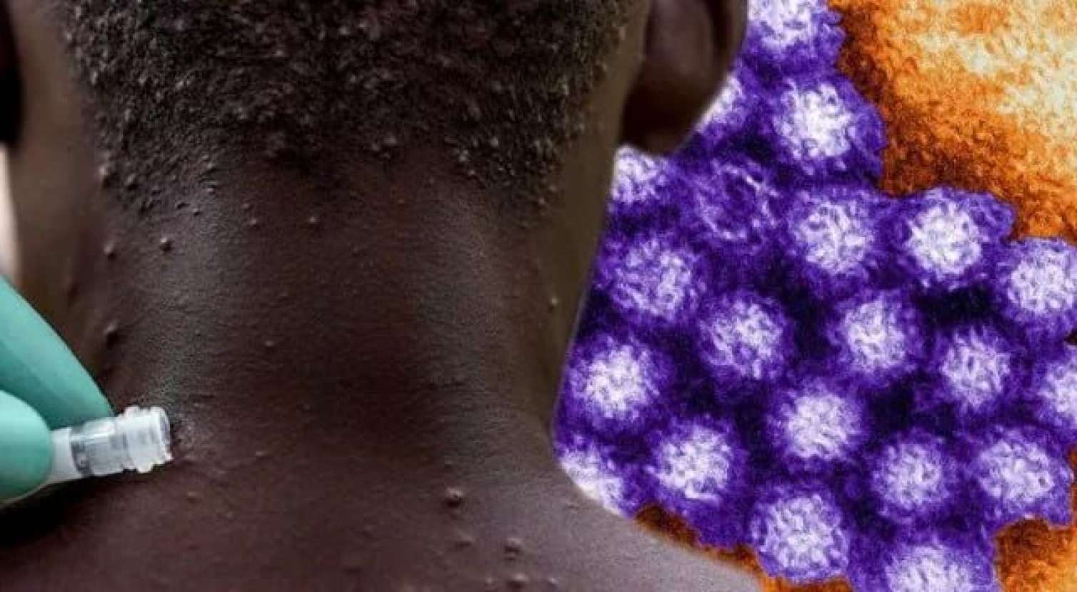 Afrikanın 12 ölkəsində meymunçiçəyi ocaqları alovlanıb 