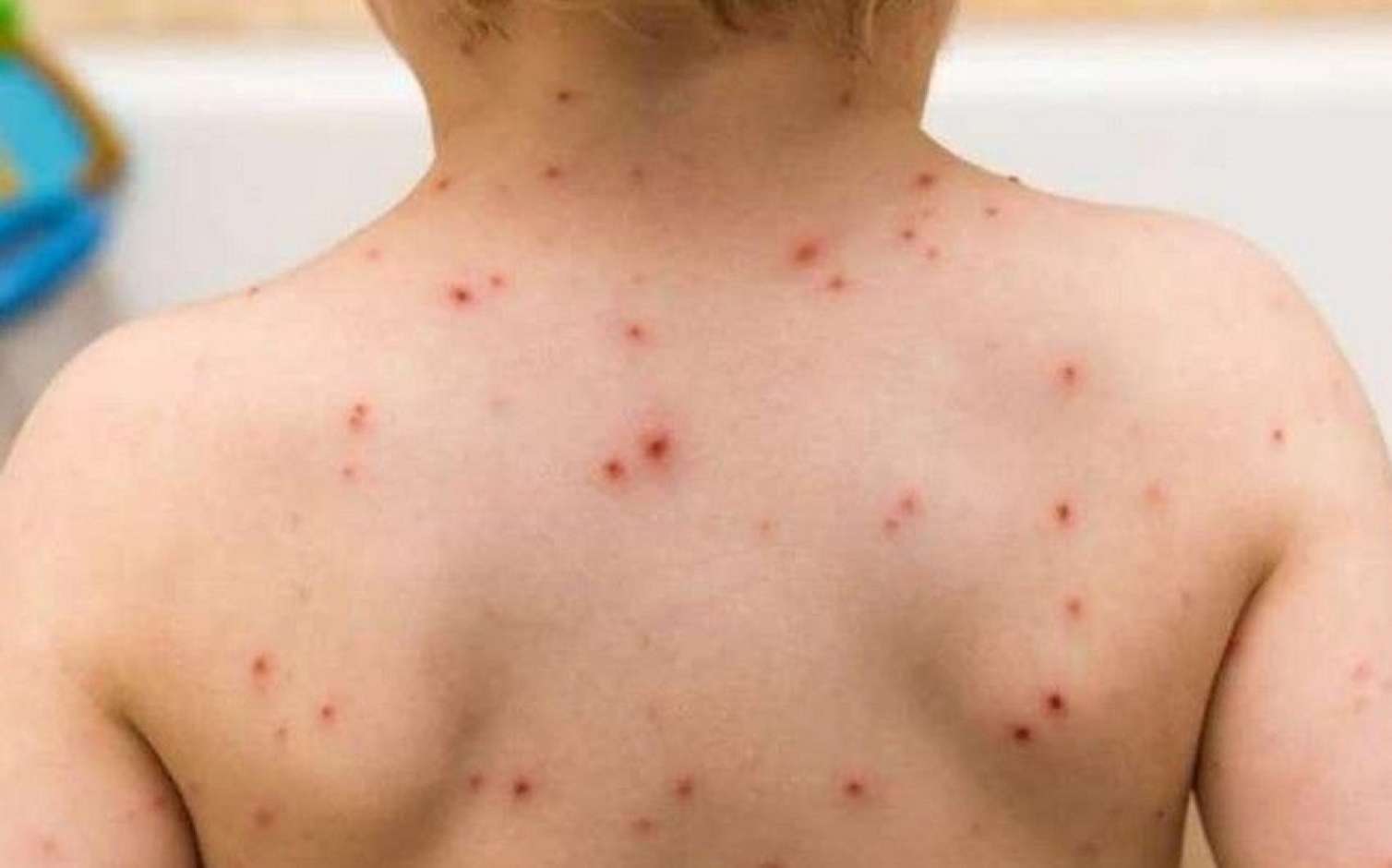 Azərbaycanda qızılca epidemyası ilə bağlı rəsmi AÇIQLAMA