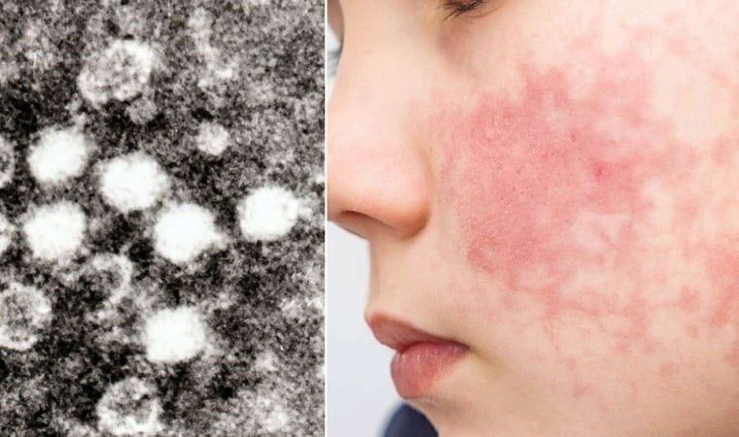ABŞ-da “parvovirus” həyəcanı: yoluxan uşaqların sayı 40 faiz artdı 