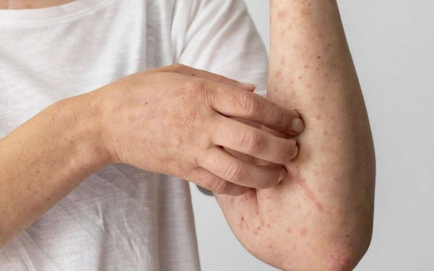 Bu ölkədə qızılca epidemiyası:  Minlərlə yoluxma, ilk ölüm halı