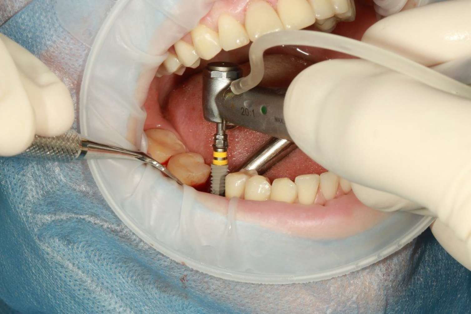 Bir gündə 12 implant diş qoyulan pasiyent öldü 