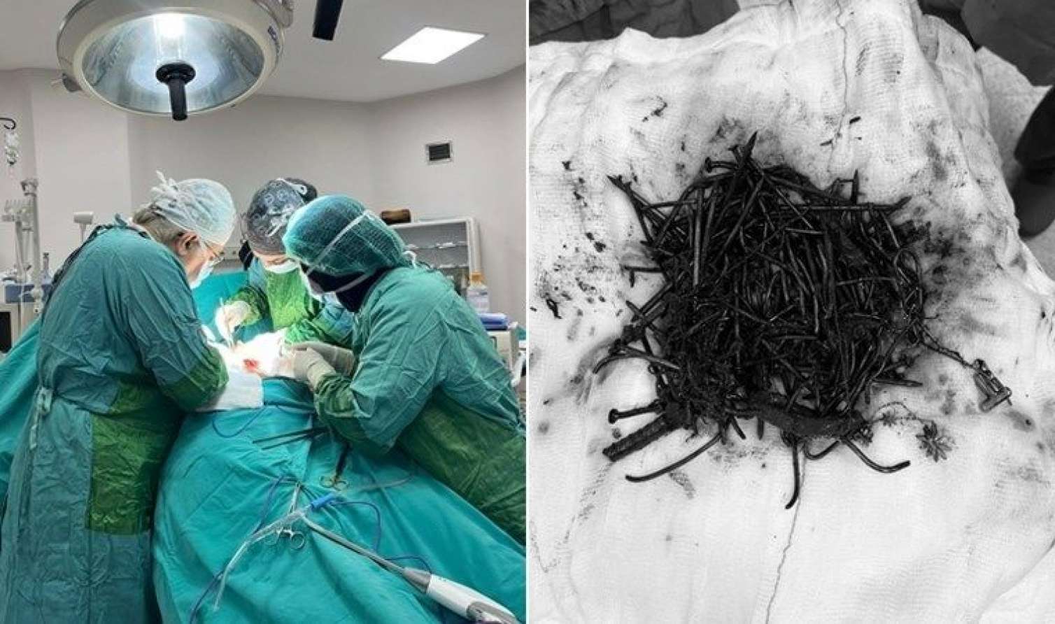 Mədəsindən 1 kilo metal əşya çıxarıldı - FOTO 