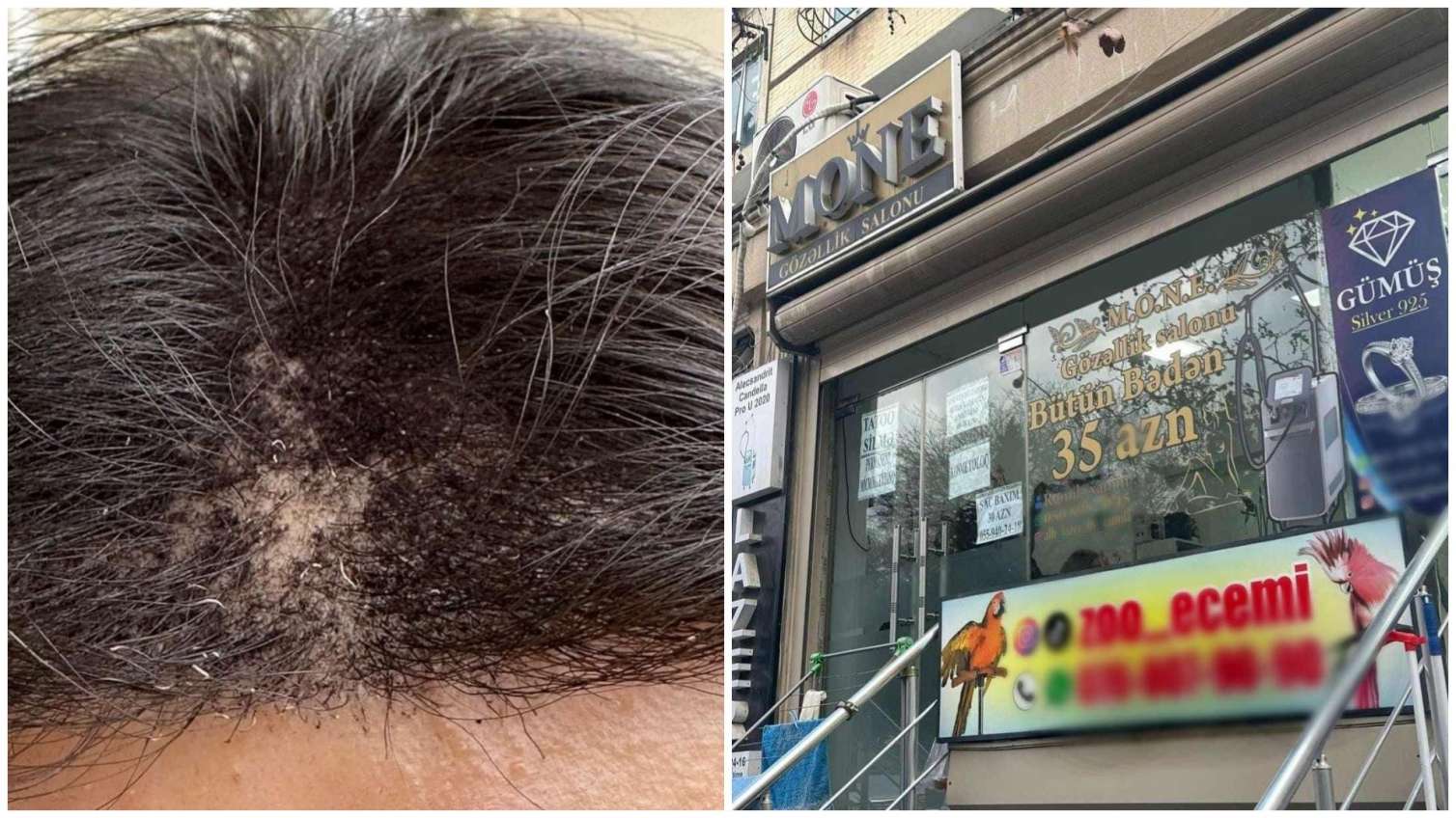 Bakıda gözəllik salonunda insident: lazerlə başı yandırılan Zeynəbdən - YENİ AÇIQLAMA+FOTO 