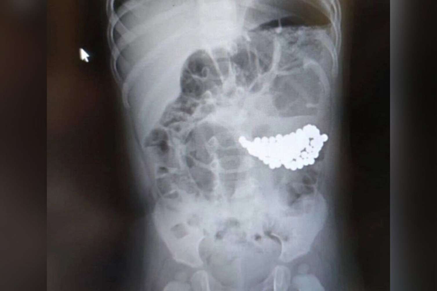 18 maqnit udan iki yaşlı uşaq öldü - FOTO 