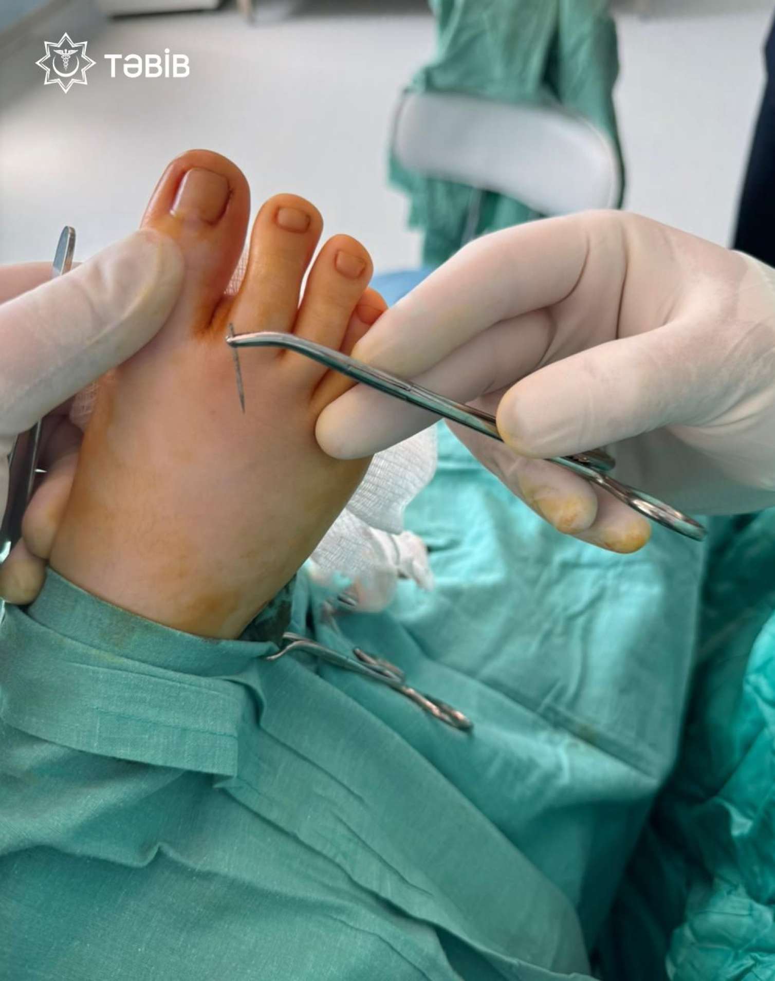 İynə uşağın ayağından 14 gün sonra çıxarıldı - FOTOLAR