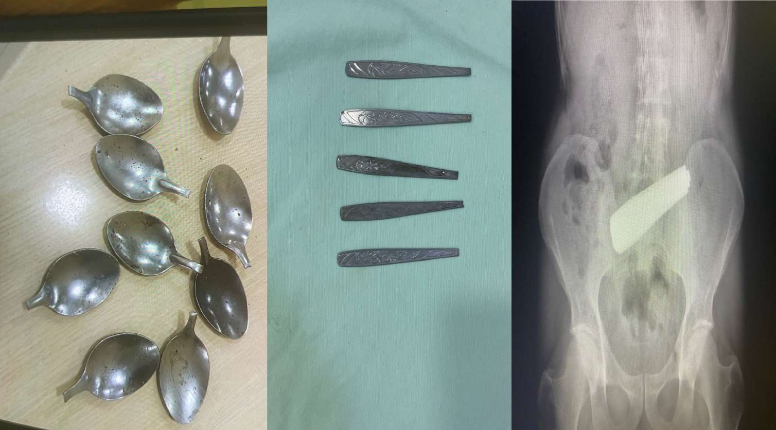 Bakı sakini 9 qaşıq uddu - Reanimasiyadadır - FOTO