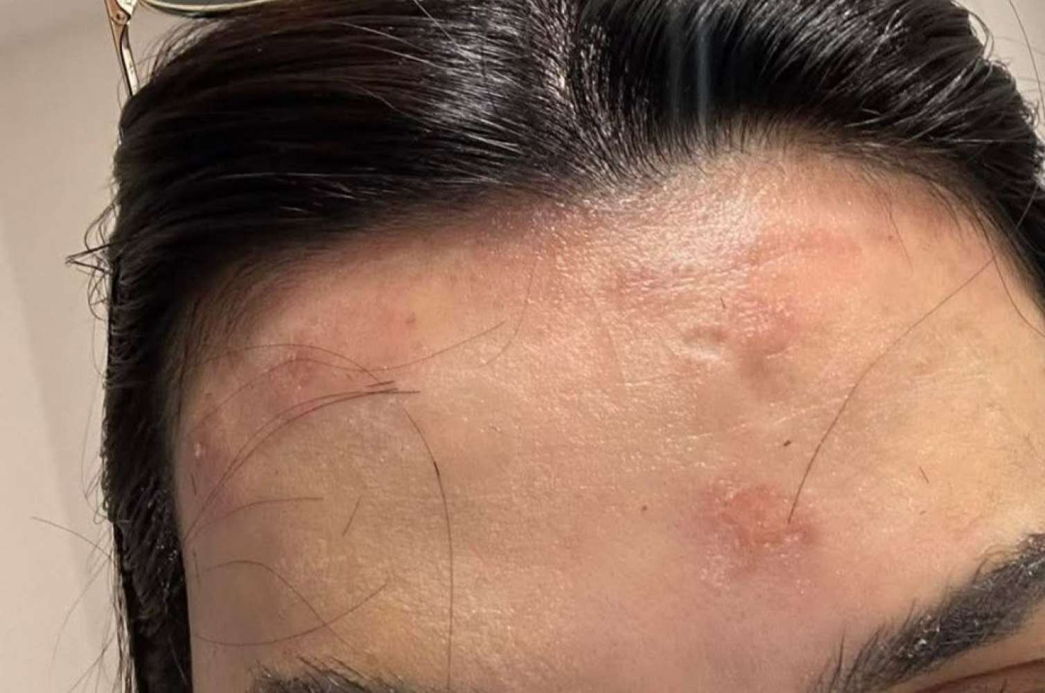 "Vecimə də deyil" - Müştərinin alnı yandığı salonun rəhbəri - FOTO