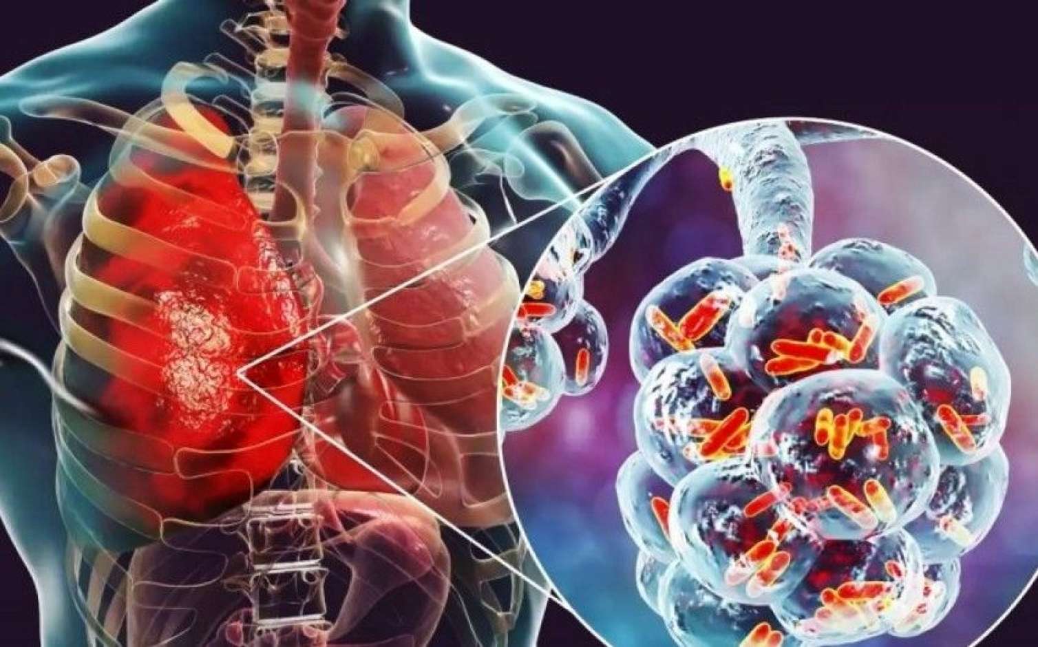 Ötən il Azərbaycanda pnevmoniyadan ölənlərin sayı AÇIQLANDI