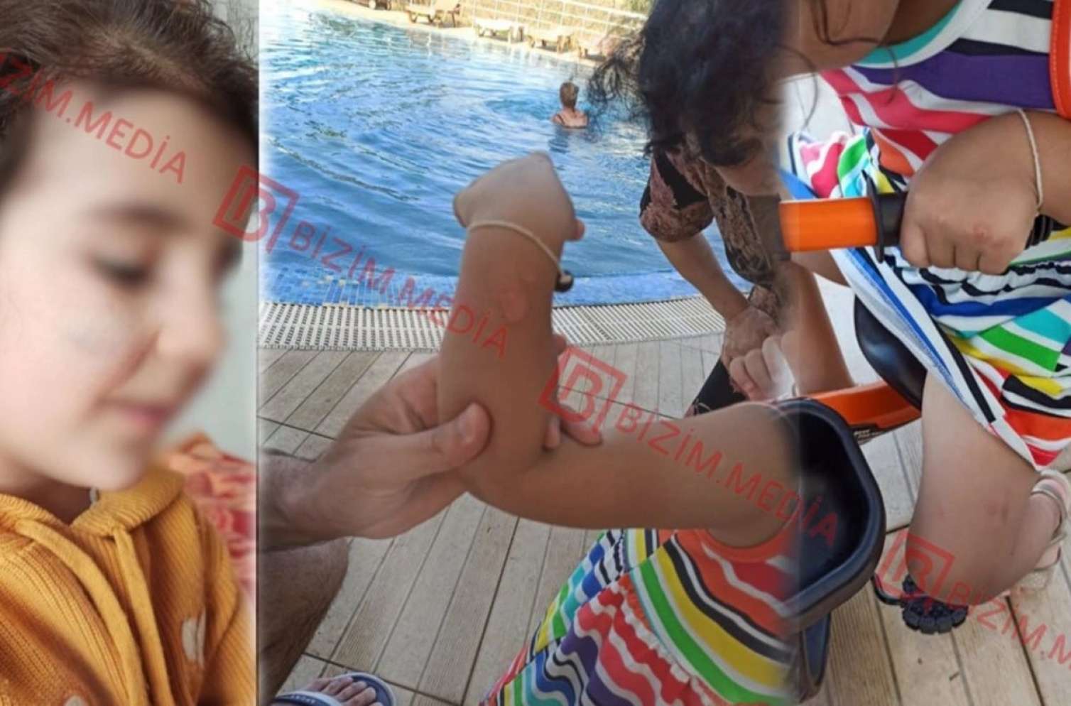 Lənkəranda qandonduran HADİSƏ – Ana isti qaşıqla 3 yaşlı qızının qolunu DAĞLADI 