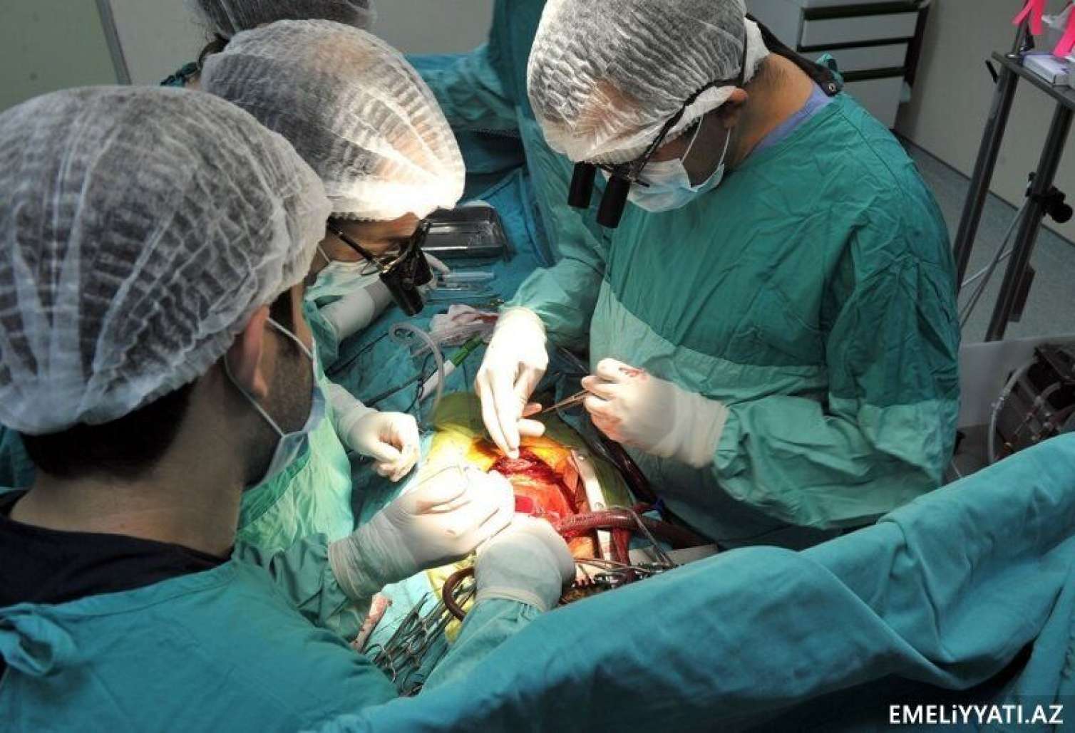 Meyitdən ürək köçürüldü – Azərbaycanda ilk dəfə 