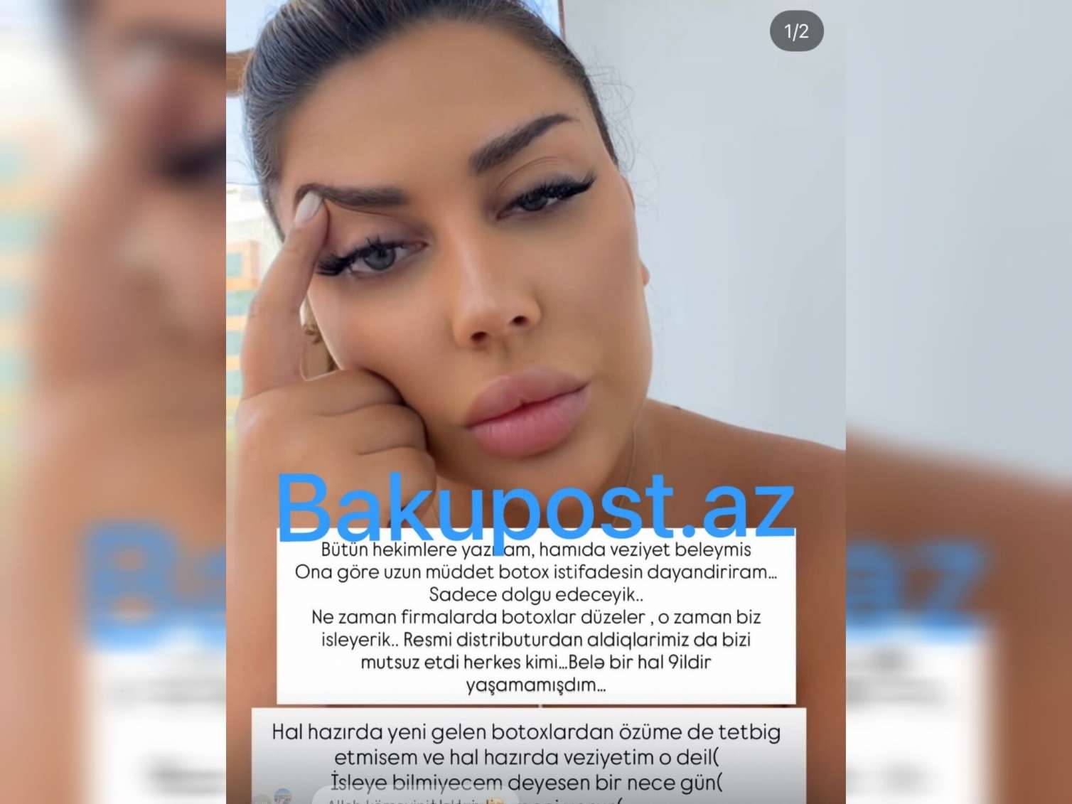 Azərbaycanda botoks vurduranlar iflic olur? – Həkim prosedurları dayandırdığını deyir