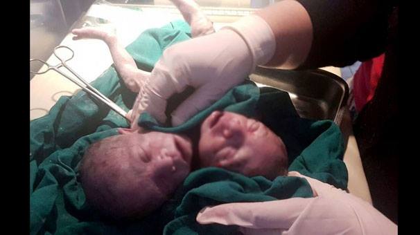  - 2 başlı uşaq doğuldu/ FOTO Hindistanda şok