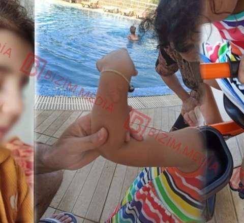Lənkəranda qandonduran HADİSƏ – Ana isti qaşıqla 3 yaşlı qızının qolunu DAĞLADI 