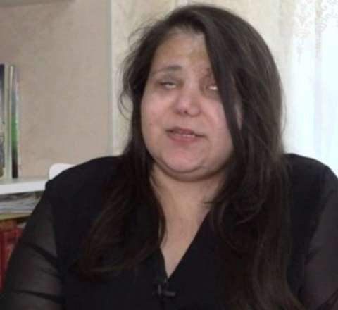 Gəncə terrorunda gözlərini itirən qadın: "Qoymayın ölüm, qızlarım var" - VİDEO 