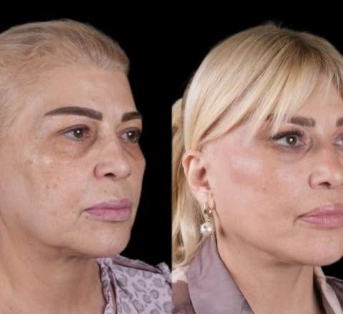 Mətanət İsgəndərlinin dəyişimi gündəm oldu -  FOTO