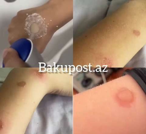 Gənclər özlərini yandırır – Sosial şəbəkələrdə qorxunc trend - Deodorant Challenge - VİDEO 