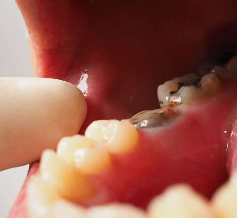 Hamilə qadının müalicəsi faciəyə çevrildi: Diş kökündə iynə tapıldı 