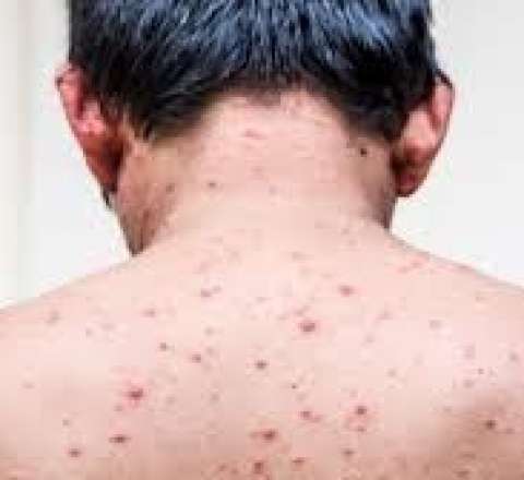 Rusiyada meymunçiçəyinə yoluxma aşkarlandı 