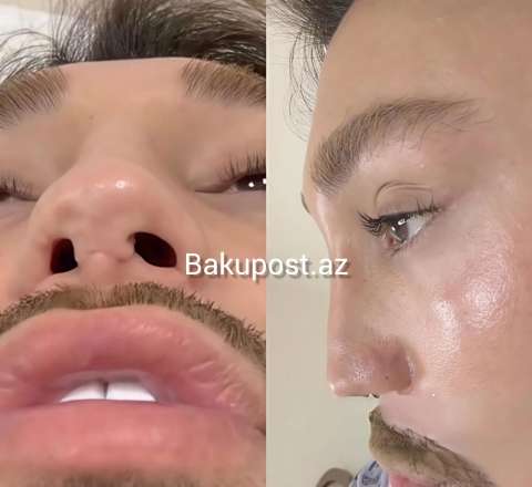 Azərbaycanın ən uğursuz plastik cərrahları: Tanınmış vizajist onları İFŞA etdi 