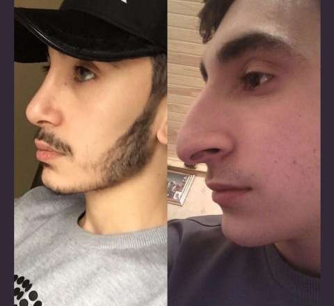 Tanınmış cərrah stilistin yalanını üzə çıxardı – “Bu burunda dəyişiklik yoxdur?” - FOTOLAR 