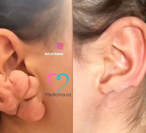 Sırğadan sonra qulağı bu hala düşdü -  VİDEO