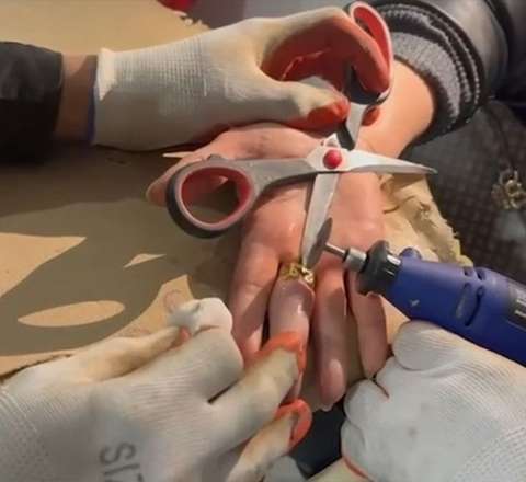 Barmağında üzük sıxışdı - Kəsib çıxardılar - VİDEO