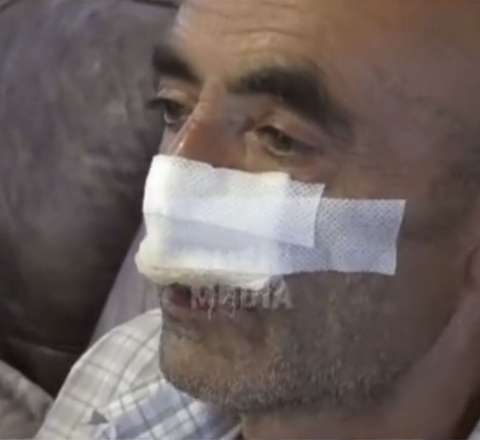 Küçə itləri 60 yaşlı kişinin burnunu  qopardı - VİDEO