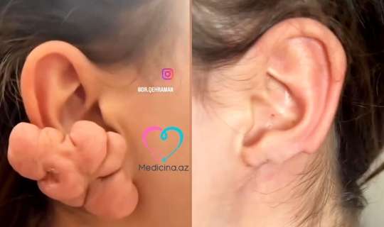 Sırğadan sonra qulağı bu hala düşdü -  VİDEO