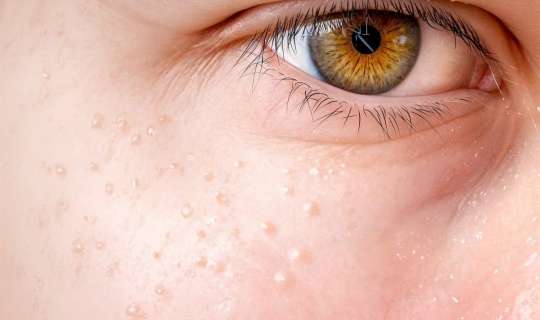 Orqanizmdə xolesterin səviyyəsinin yüksək olduğunu necə bilmək olar? - Üzdə nəzərəçarpan əlamətlər 