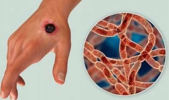 Qarayara xəstəliyi necə yayılır? -  VACİB AÇIQLAMA