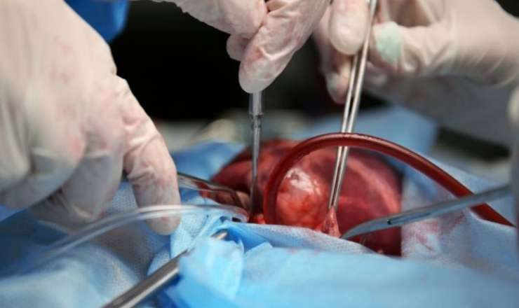 Orqan alverinə qarşı konvensiyaya qoşulan 16-cı ölkə – Xəstə sayı donorlardan 6 dəfə çoxdur 