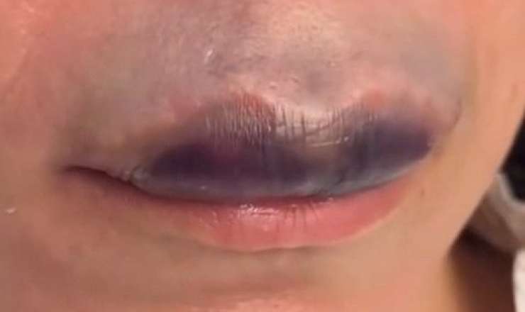 Daha bir qadın estetik qurbanı oldu -  VİDEO