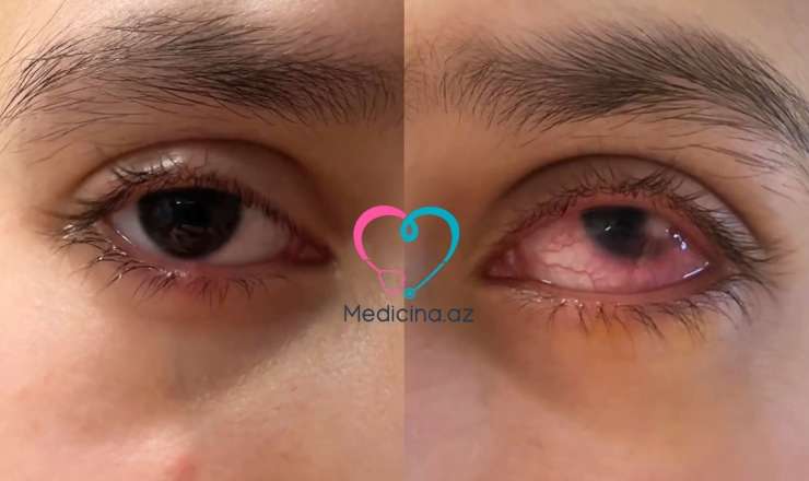 Çox şirniyyat yeyən uşağın gözü dəhşətli hala düşdü -  VİDEO