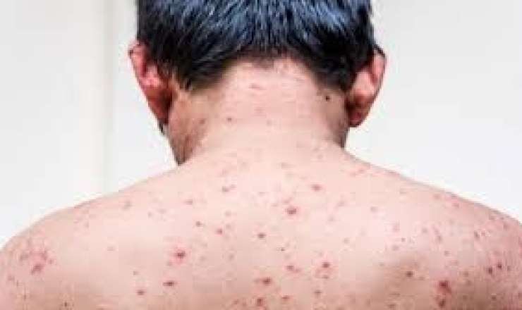 Rusiyada meymunçiçəyinə yoluxma aşkarlandı 