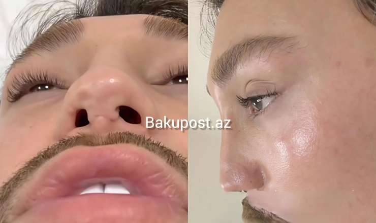 Azərbaycanın ən uğursuz plastik cərrahları: Tanınmış stilist onları İFŞA etdi - VİDEO