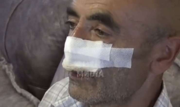 Küçə itləri 60 yaşlı kişinin burnunu  qopardı - VİDEO